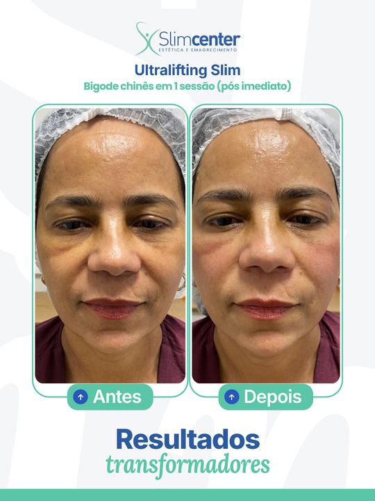 Antes e depois de Ultralifting Slim