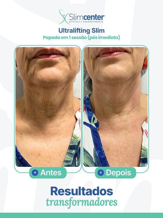Antes e depois de Ultralifting Slim