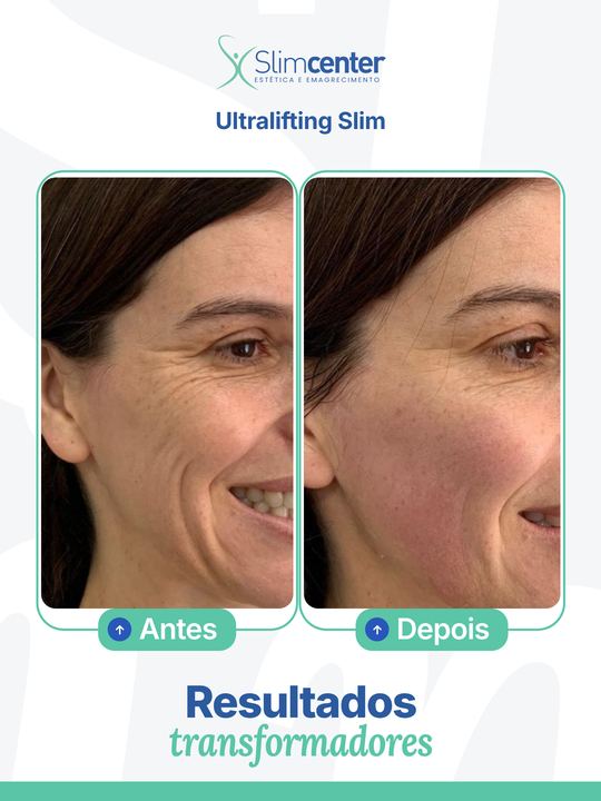 Antes e depois de Ultralifting Slim